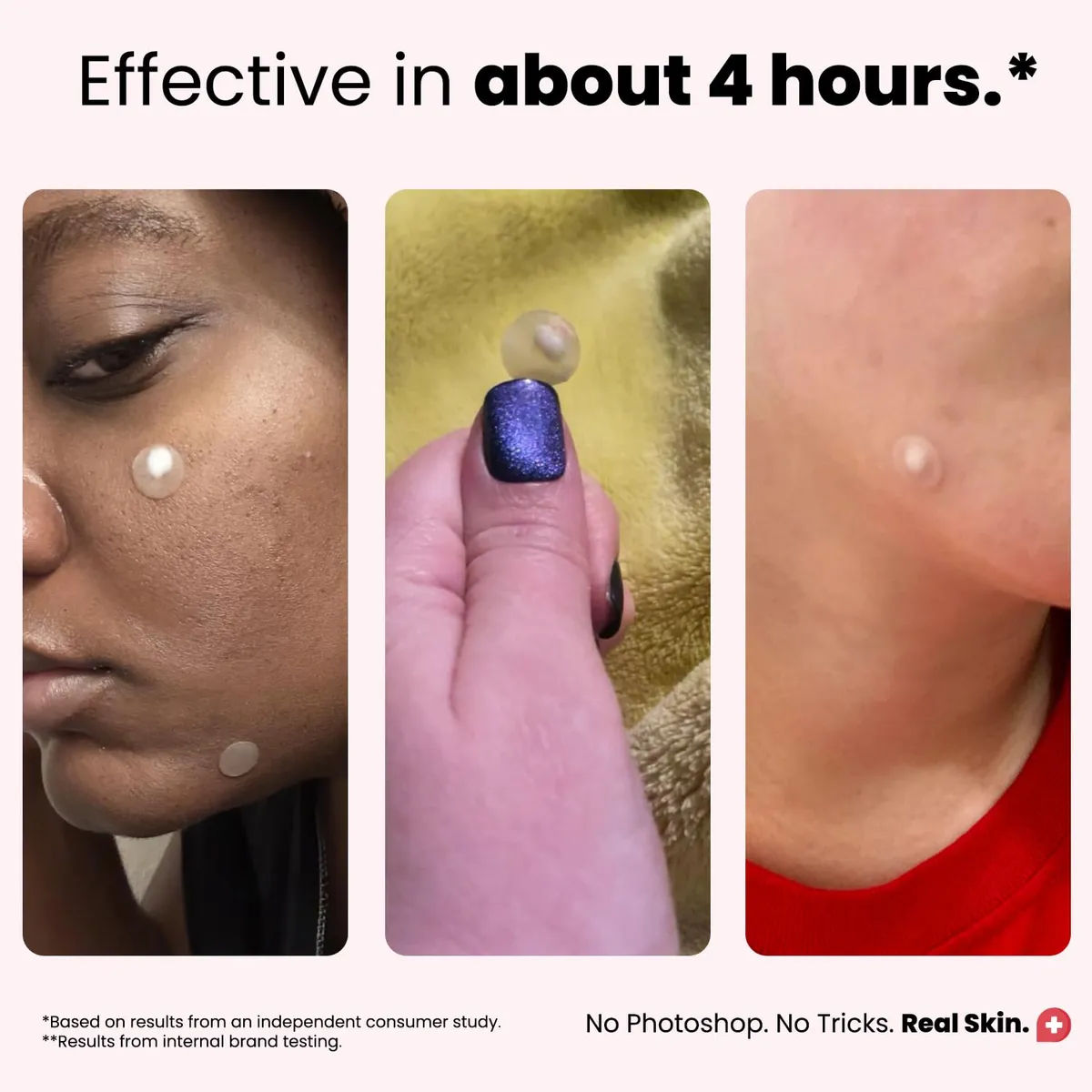 ROSELYNBOUTIQUE Pimple Patches for Face 300 Counts 4 Sizes Hydrocolloid Acne Patches with Tea Tree Oil