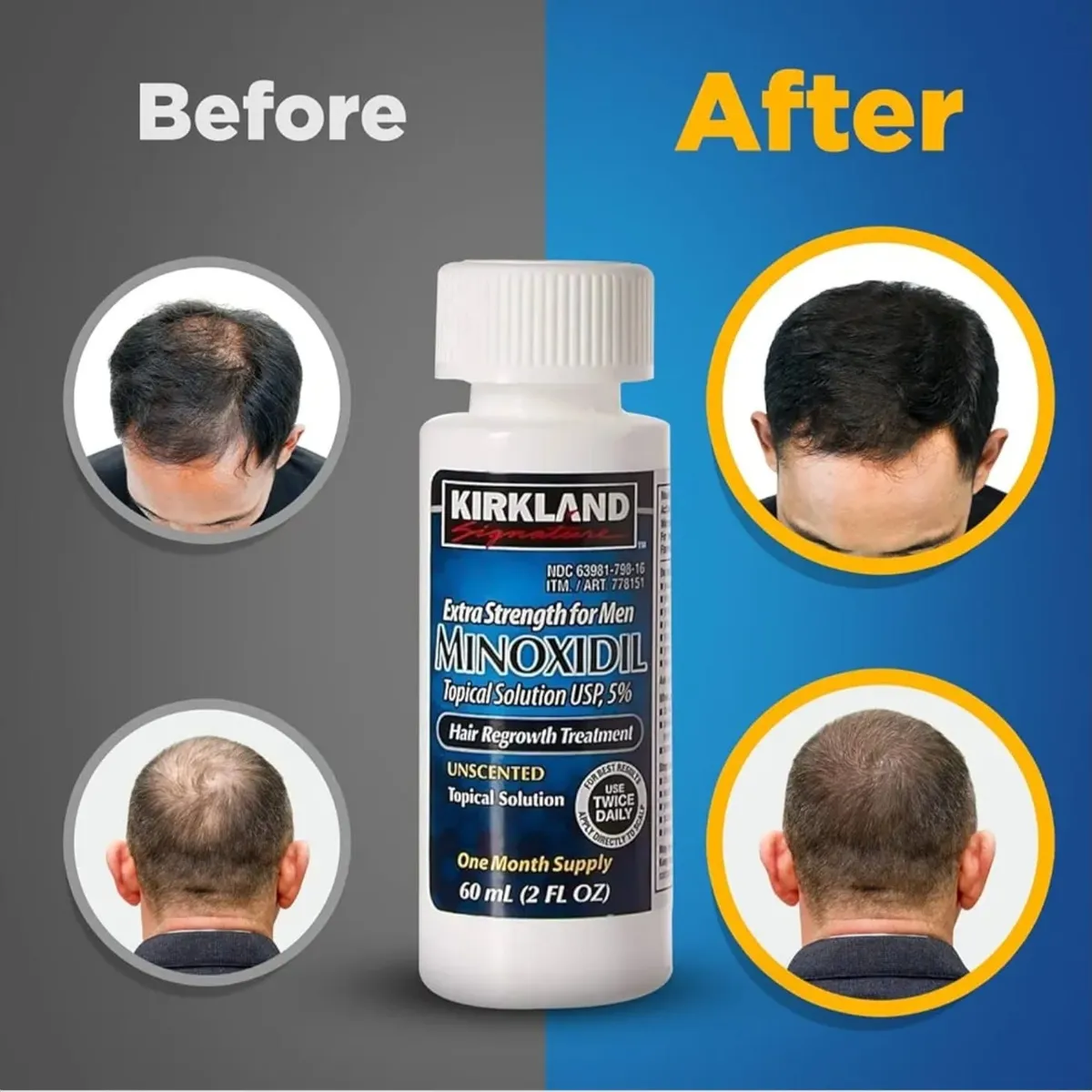Kirkland Signature 5% Minoxidil Hair Regrowth for Men - 1 Month Supply