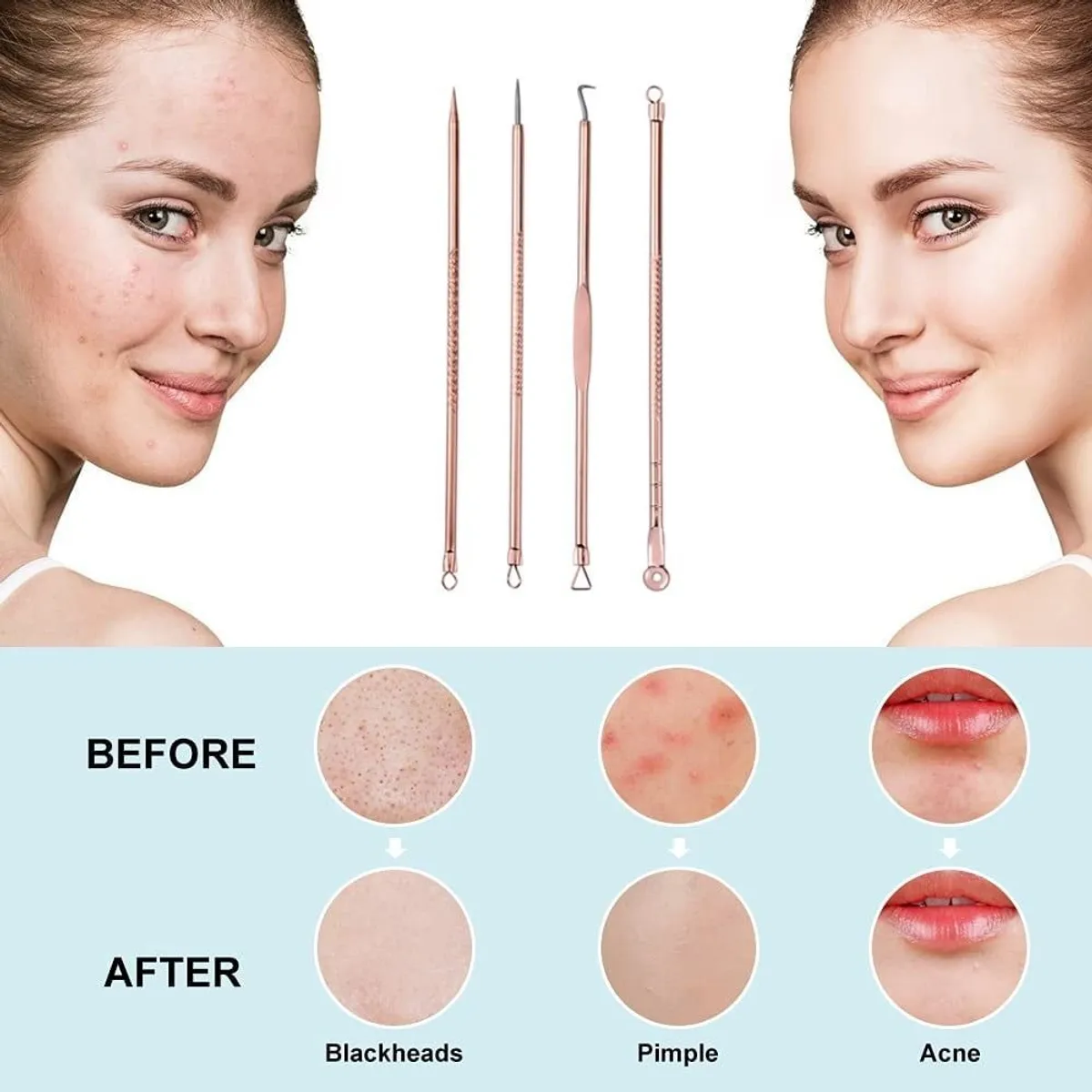 Blackhead Removal Tool Kit