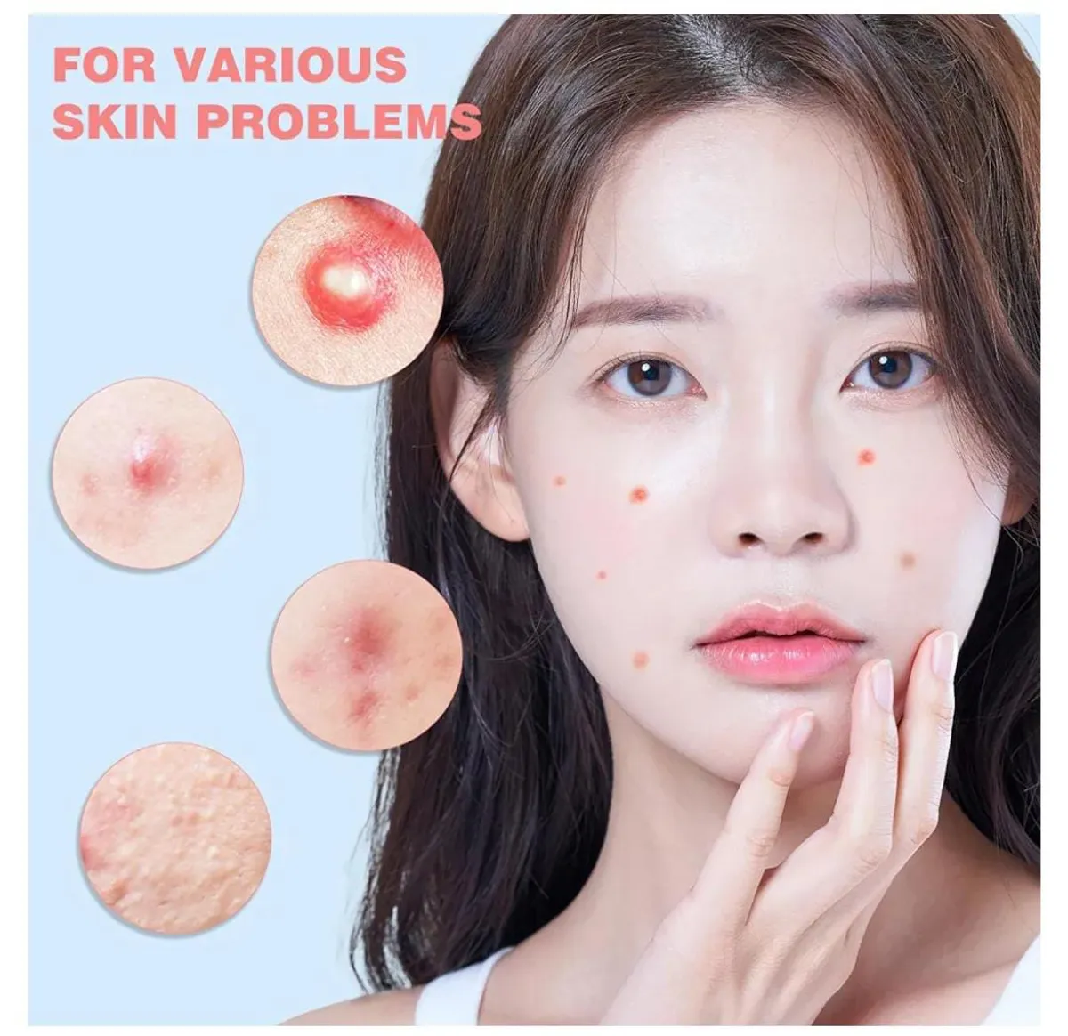 Hiloes Pimple Patches For The face 260 Pieces hydro-colloid Acne Patches To Cover Pimples And Blemishes