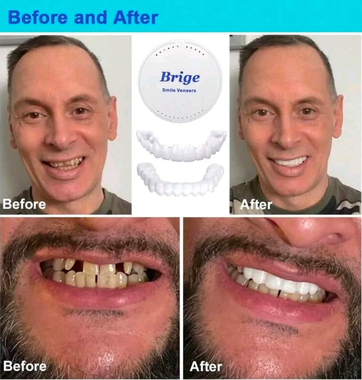 Silicone Cosmetic Smile Veneers Temporary Decorative Fake Teeth